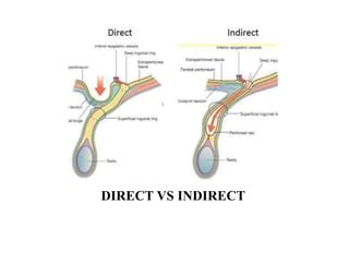 hernia inguinalis lateralis